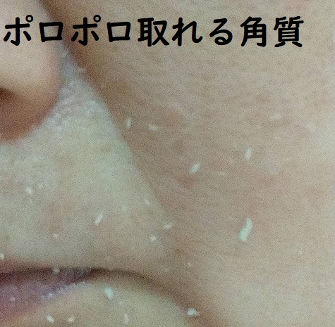 シミニーで取れる角質
